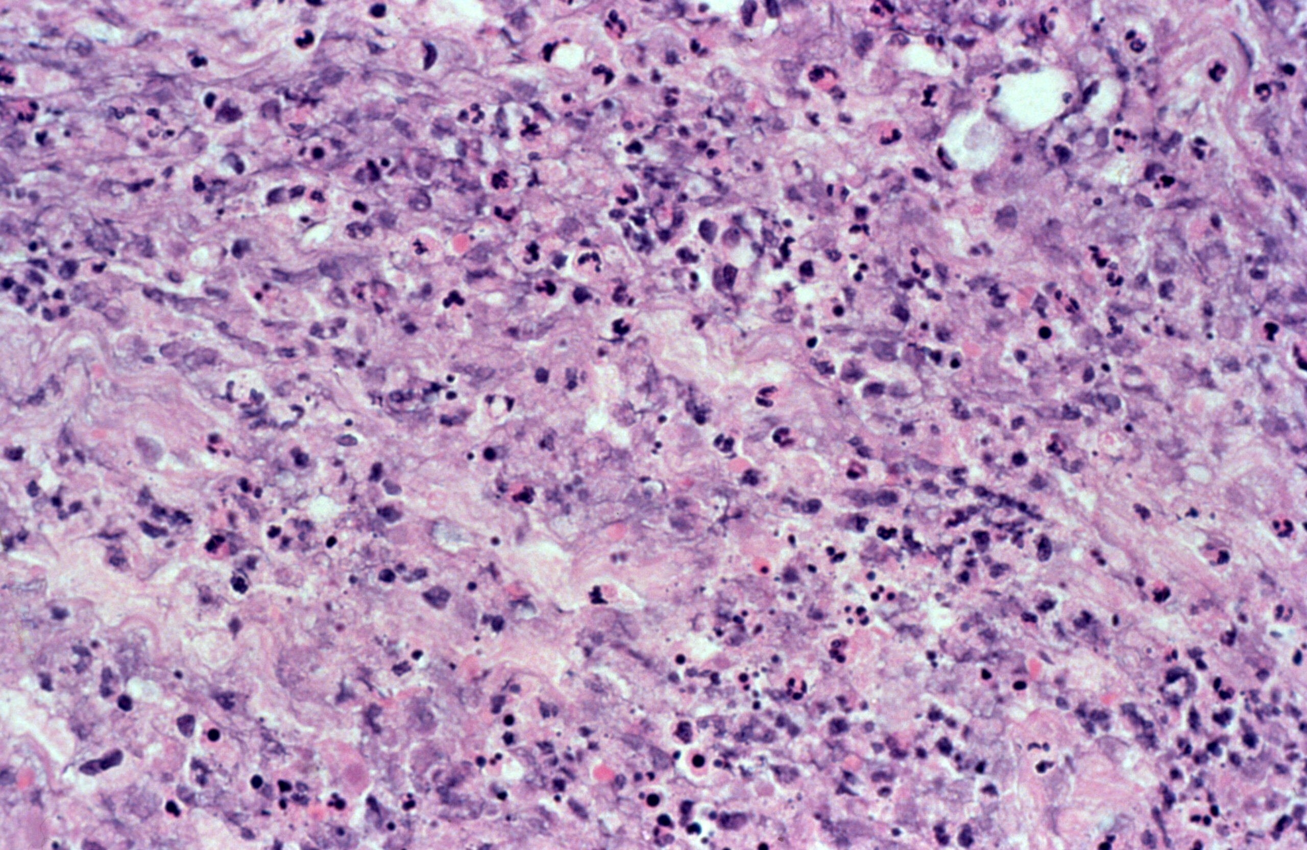 Erythema Nodosum Leprosum: Proven Insights on Treatment Effects